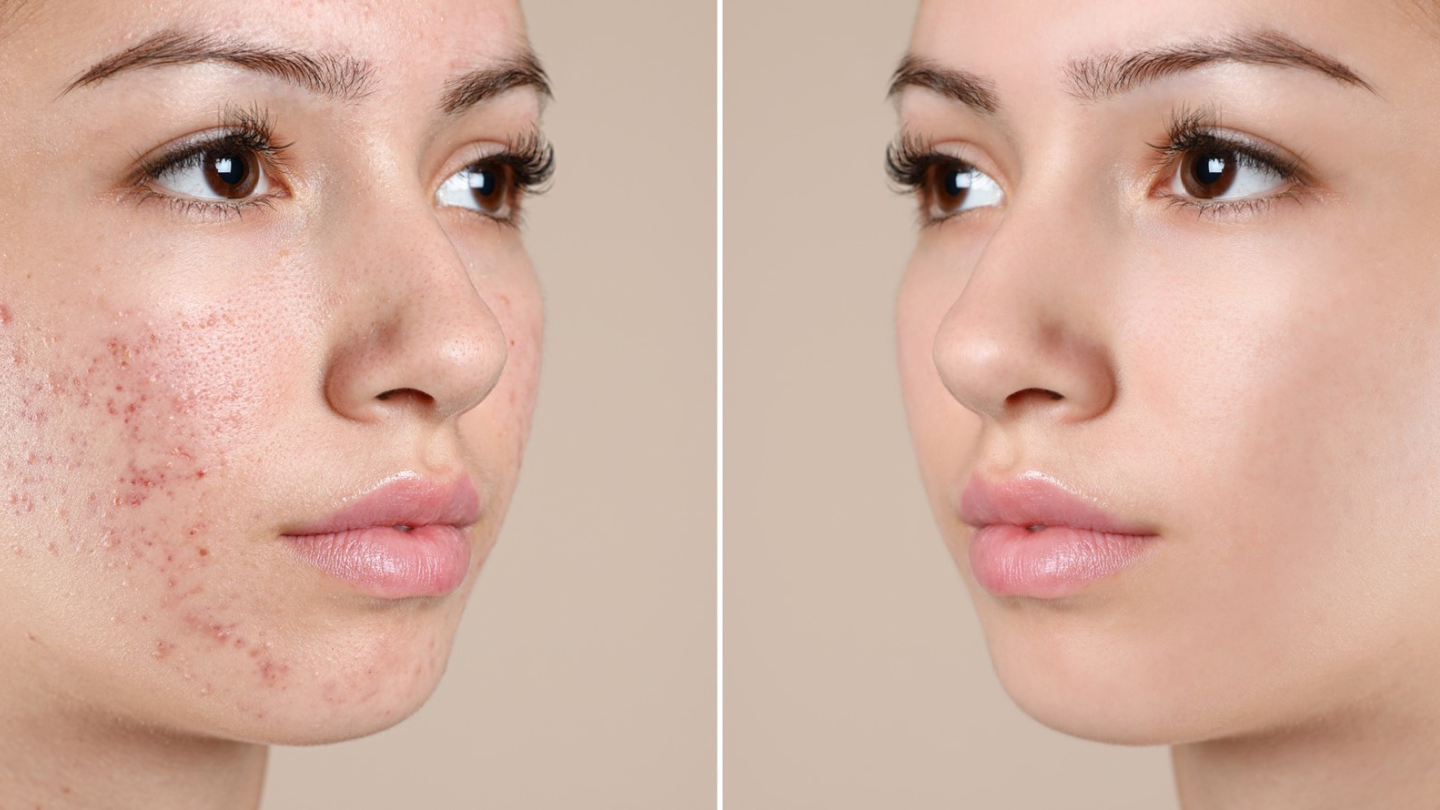Acne & Breakouts