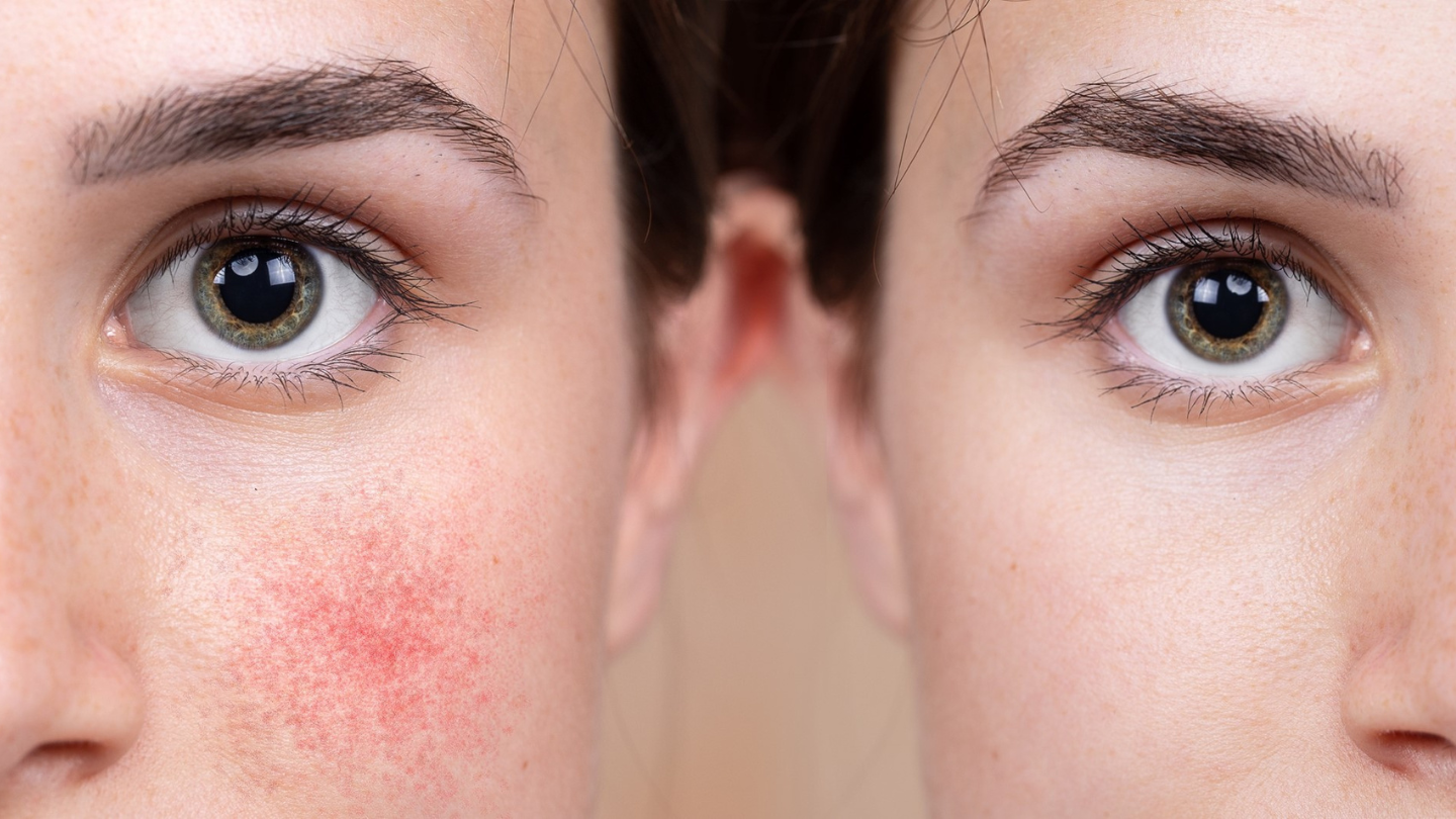 Redness & Rosacea