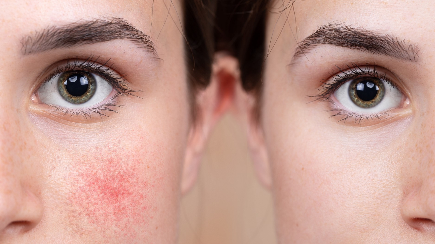 Redness & Rosacea – MySkinSolution®